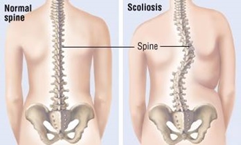 Skolyoz Nedir?